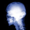 Skull Implants X Ray Backgrounds For Powerpoint – Health And With Radiology Powerpoint Template